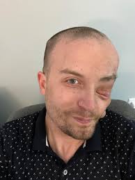 Living with neurofibromatosis type 1