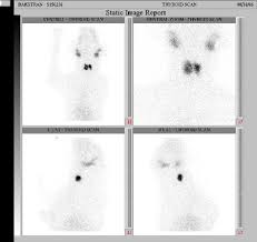 How long does someone live with leuukemia? Thyroid Tumors In Dogs And Cats Sciencedirect