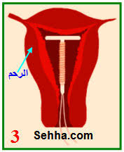 الوسائل الرحمية لمنع الحمل اللولب Intrauterine Device Iud طريقة عمله منتديات كويتيات النسائية