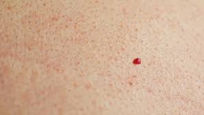 A cherry angioma is a small papular angioma. What Does Cherry Angioma Lead To With Best Treatment Yummylooks