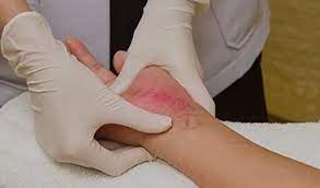 Its advice that you get urgent wound care from a wound care center nyc. Wound Care Find A Service Holy Cross Health
