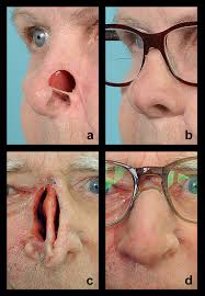 Chemical used to cauterize nose x 10 min = ___. Patient Without A C And With Prosthesis Attached On Glasses B D Download Scientific Diagram