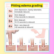 Image result for Edema Exam