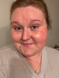 Can azelaic acid be used with benzoyl peroxide or salicylic acid?