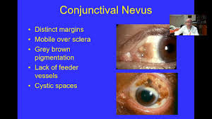 Image result for conjunctival melanoma