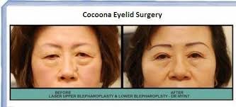 Blepharoplasty Surgery And Its Cost In India What You Should Know About Blepharoplasty Surgery Laser Eye Surgery Cost Reduction Surgery Fungus Treatment