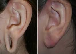 Earlobe Recovery After Gauge Piercings