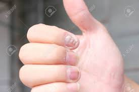 La Infeccion De Hongos En Las Unas De La Mano Los Dedos Con La Onicomicosis Enfoque Suave Fotos Retratos Imagenes Y Fotografia De Archivo Libres De Derecho Image 59854753