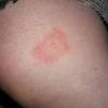 Pancreatic cancer symptoms and signs often do not manifest until the cancer has metastasized. 1