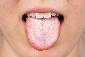 Image result for oral thrush symptoms roof of the mouth