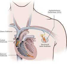 What is a subcutaneous icd? Wie Funktioniert Ein Implantierbarer Defibrillator Icd