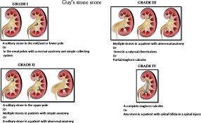 Image result for STONE Score