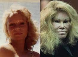 Getty images jocelyn wildenstein is a poster child for plastic surgery gone wrong, says dr. Catwoman Was A Real Beauty Before Plastic Surgery Demotix