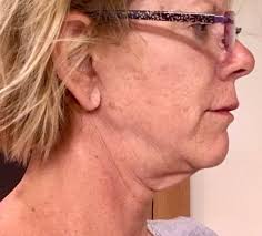 Lisa J. Learn, DO, Board Certified Plastic Surgeon