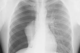 Image result for Pneumothorax