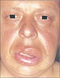 Diseases of the Lips and Oral Mucosa