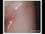 Pubic Area Cyst Ingrown Hair