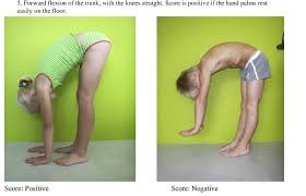 Image result for Hypermobility Signs