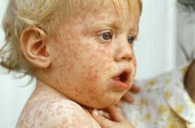 Why do measles survivors get sicker?