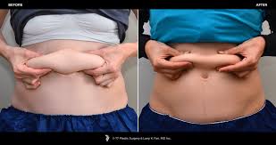She is 5'4 and weighs 129 pounds. 5 Coolsculpting Before And After Stories And How To Get The Same Results