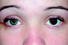 A Case Of Horner Syndrome With Intermittent Mydriasis In A Patient With Hypoplasia Of The Internal Carotid Artery American Journal Of Neuroradiology