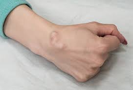 Evaluation and management of a hard lump on side of neck depends on the clinical context; Ganglion Cyst Pain Relief Treatment Removal Cure