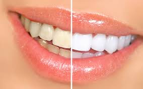 Chino aesthetic dental is on facebook. Cosmetic Dentist In Downey Priority Dental Group