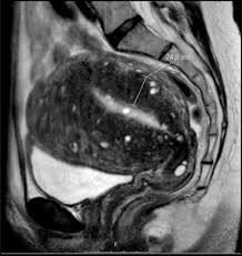 Anthony pompliano recommended for you Uterine Artery Embolisation In Women With Symptomatic Adenomyosis Sciencedirect