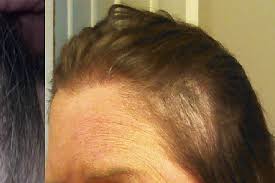 Since hair loss isn't life threatening, some physicians won't even treat it. Wen Hair Care Lawsuit See Photos Of Hair Loss People Com