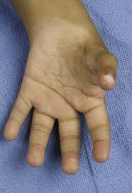 Image result for Supernumerary Digit