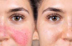Image result for red rash face