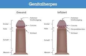 Herpes genitalis ist eine ansteckende erkrankung. Genitalherpes Definition Mittel Gegen Genitalherpes Online
