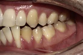 So retainers really aren't so bad! Canine Avulsion An Extreme Complication Of A Fixed Mandibular Lingual Retainer American Journal Of Orthodontics And Dentofacial Orthopedics