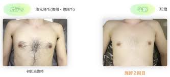 胸毛が生える人と生えない人の違いは？おすすめの胸毛の減らし方を紹介 | メンズ脱毛百科事典 リンクスペディア