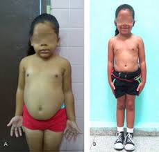Sindrome De Van Wyk Grumbach