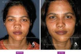 Nose surgery by curls and curves hair transplantation & cosmetic surgery centre (rajaji nagar) location: Nose Reshaping Surgery Or Nose Job Rhinoplasty Costs In Pune