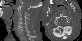 Traumatic Posterior Atlanto Axial Dislocation Case Report Of An Atypical C1 C2 Dislocation With An Anterior Arch Fracture Of C1 Bmc Musculoskeletal Disorders Full Text