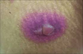 Image result for Fixed Drug Eruption