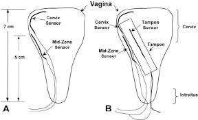 Placement Of Vaginal Sensors In Vaginal Canal Pre A And