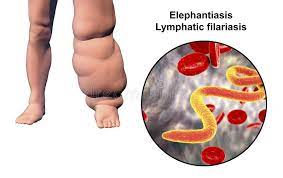 This disease also goes by the name lymphatic filariasis or elephantitis. Leg Of A Person With Elephantiasis Lymphatic Filariasis Stock Illustration Illustration Of Parasites Lymphedema 116205199