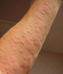 How Can You Get Hives Natural Remedies Natural Remedies For Hives Natural Cough Remedies Urticaria