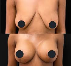 تكبير الثدي صور قبل وبعد | Bookimed