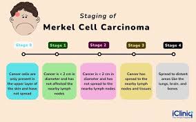 Image result for Merkel Cell Carcinoma