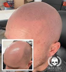 But we do more than create products. Hair Loss Solution For Men Skulltec Smp