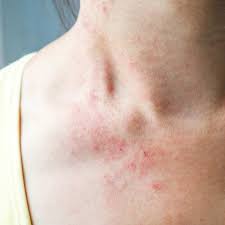 Image result for contact dermatitis