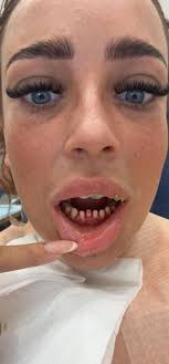 I got £4K Turkey teeth even though they won't last past my 35th birthday