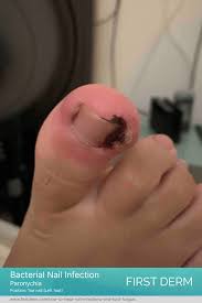 Image result for Paronychia feet
