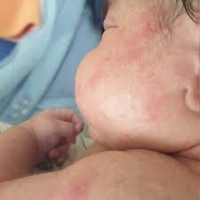 Choosing organic baby wash is an even bigger plus. Asktheexpert Hello Sir My Baby Is Developing Rash After Bathing And It Subsides After Few Minutes What Could Be The Reason I First Used Johnson Baby Soap And Then Shifted To Teddibar