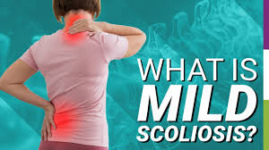 Mild Scoliosis - Symptoms, Treatment ...
