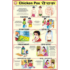 Chicken Pox Chart 50x75cm